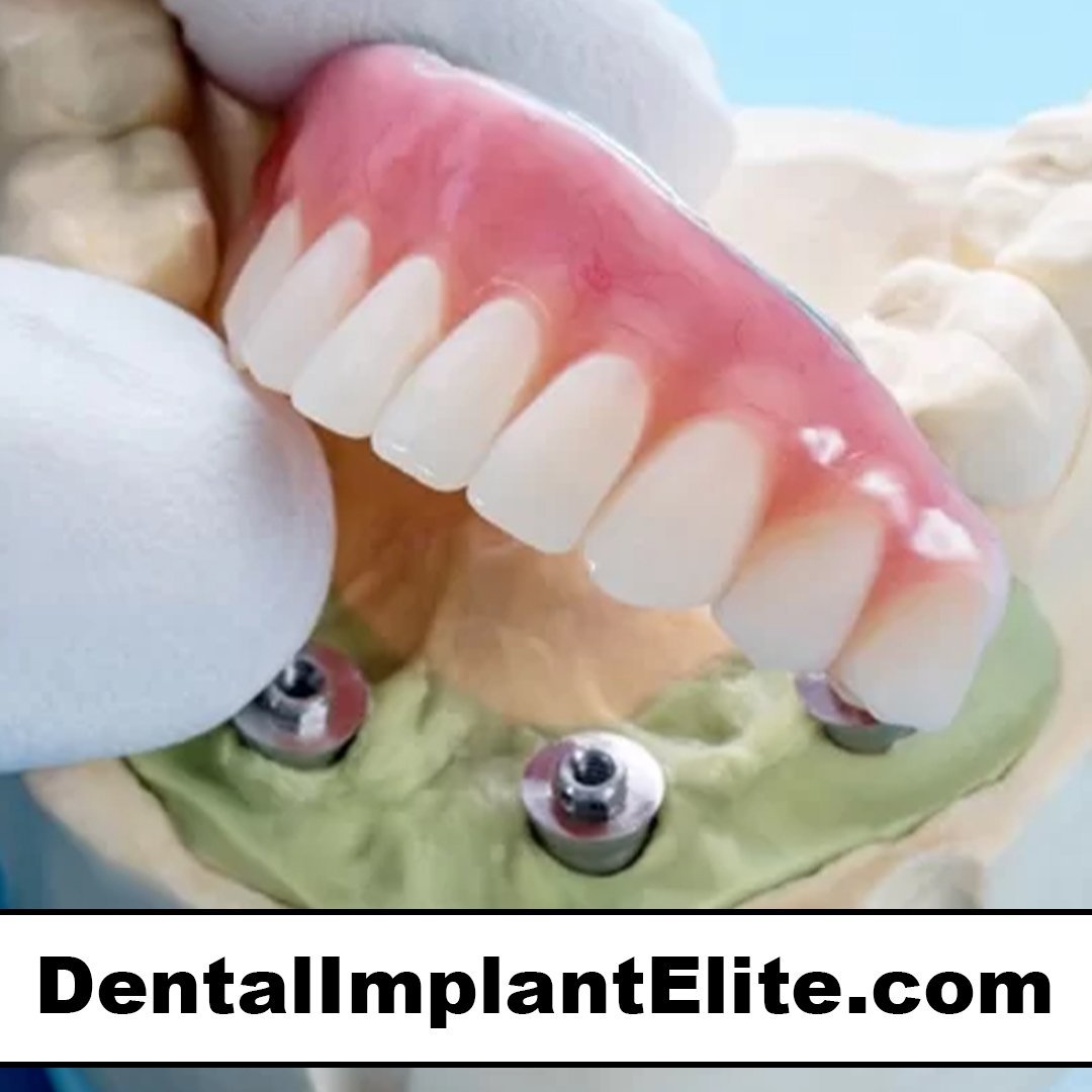 dentalimplantelite.com