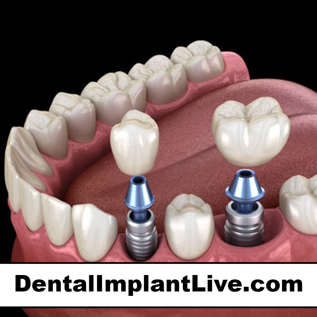 dentalimplantlive.com
