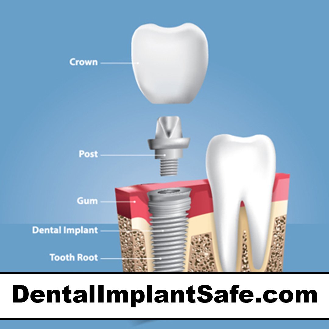 dentalimplantsafe.com