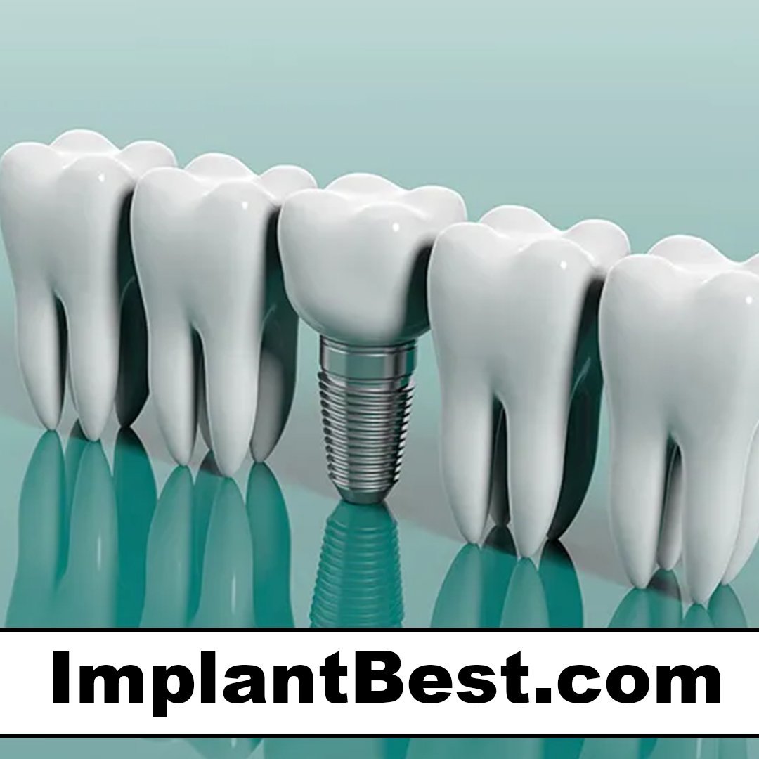 implantbest.com