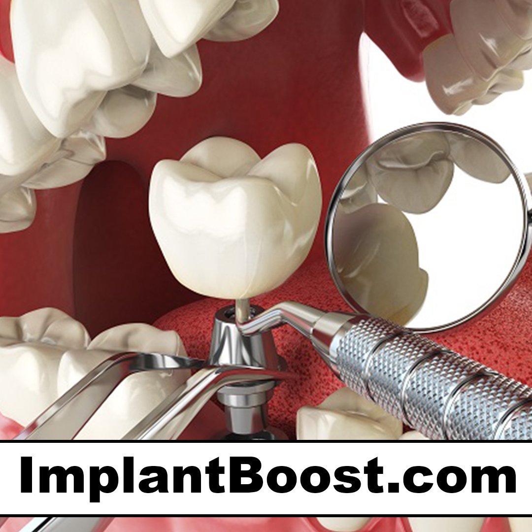 implantboost.com