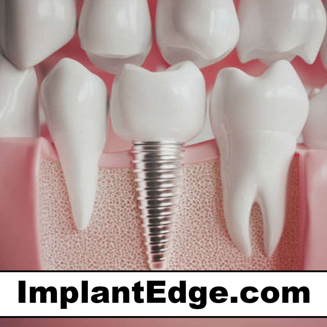 implantedge.com