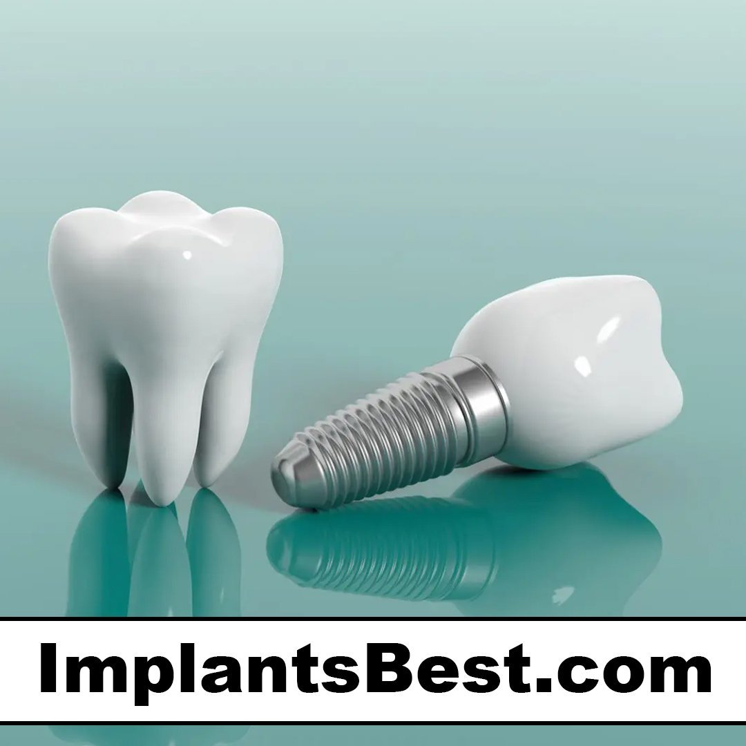 implantsbest.com