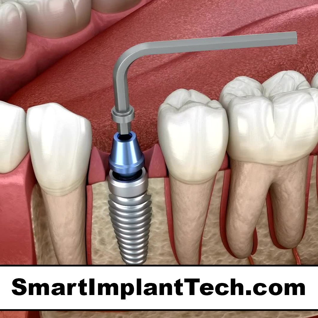 smartimplanttech.com